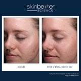 Before and after results using skinbetter science AlphaRet Clearing Serum