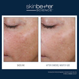 Before and after results using skinbetter science AlphaRet Overnight Cream