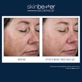 Before and after results using skinbetter science Alto Advanced Defense and Repair Serum