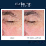 Before and after results using skinbetter science EyeMax AlphaRet Overnight Cream