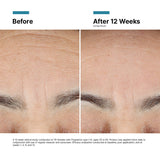 Before and after results using SkinCeuticals Advanced RGN-6