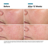 Before and after results using SkinCeuticals Advanced RGN-6