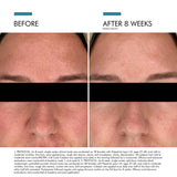 Before and after results using SkinCeuticals Clear Daily Soothing UV Defense Sunscreen SPF 50