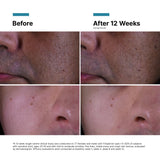 Before and after results using SkinCeuticals P-TIOX Anti-Wrinkle Cream