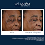 Before and after results using skinbetter science Mystro Active Balance Serum