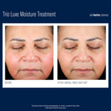 Before and after results using skinbetter science Trio Luxe Moisture Treatment