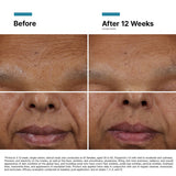 Before and after results using SkinCeuticals H.A. Intensifier Multi-Glycan