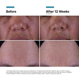 Before and after results using SkinCeuticals P-TIOX Anti-Wrinkle Cream