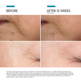 Before and after results using SkinCeuticals P-TIOX Anti-Wrinkle Serum