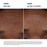 Before and after results using SkinCeuticals P-TIOX Anti-Wrinkle Serum